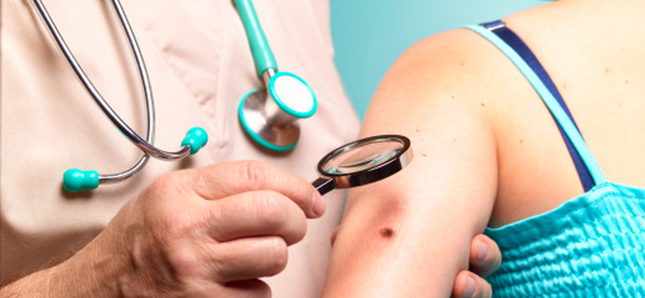 Benler ve Deri Kanseri